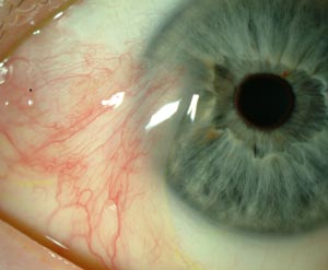 pterygium