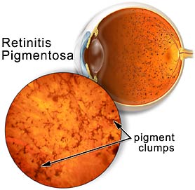 retinitis_pigmentosa