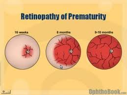 retinopathy