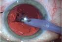 Conductive keratoplasty