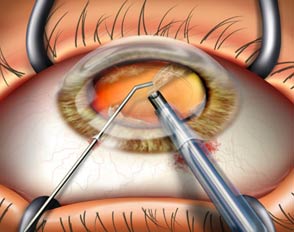 cataractsurgery