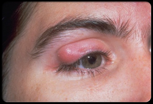 chalazion