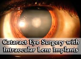 intraocular