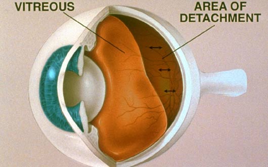 pneumatic retinopexy