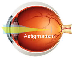 astigmatism