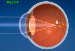 myopia