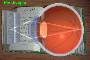 presbyopia